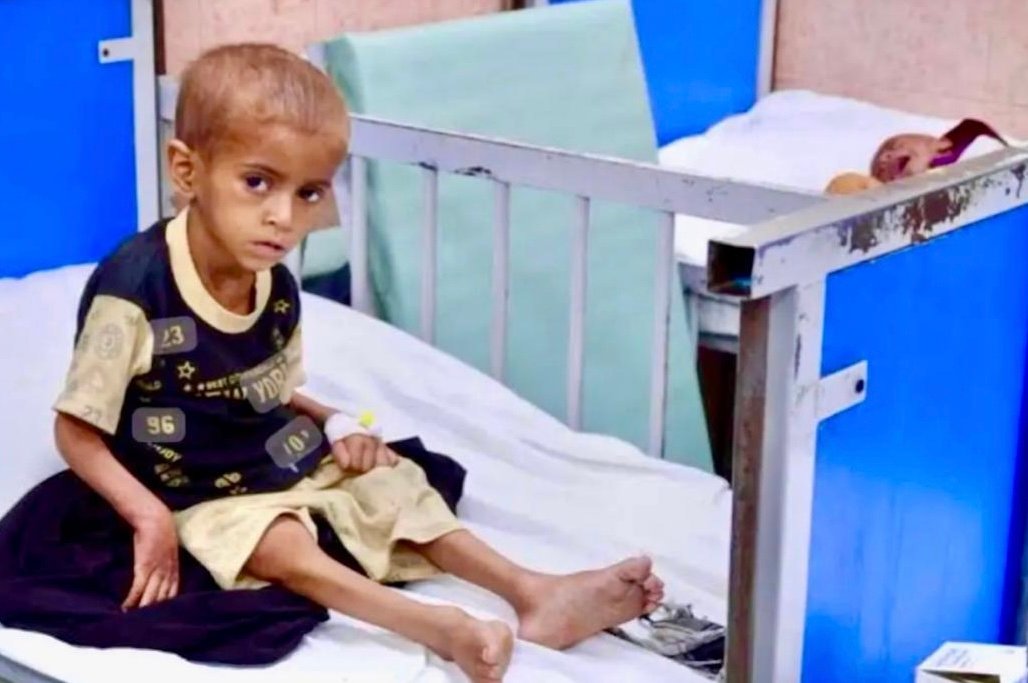 یونیسف: شمار کودکان سوءتغذیه در افغانستان از مرز ۳ میلیون گذشت