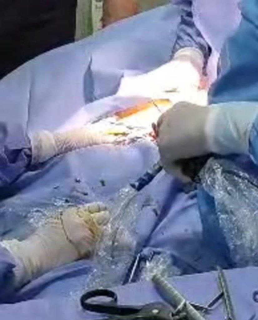 جراحی لاپاراسکوپی برای نخستین&zwnj;بار در شفاخانه حوزوی هرات انجام شد